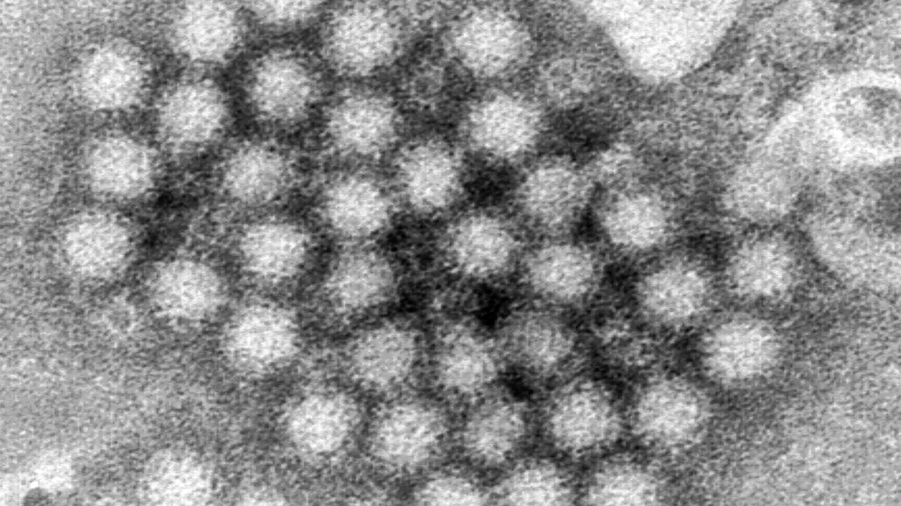 Norovirus cases surge in US: What you need to know about this stomach bug